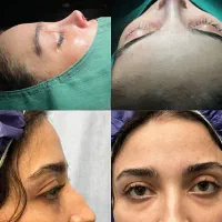 جراحی بینی در تهران با آف ۵۰درصد،جشنواره آذر|خدمات آرایشگری و زیبایی|پاکدشت, پاکدشت (مامازند)|دیوار