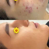 کرم سفید کننده وضدلک|آرایشی، بهداشتی، درمانی|اهواز, کمپلو جنوبی|دیوار