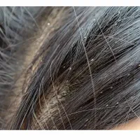 پاکسازی تخصصی شپش زیر نظر استاد حرفه ای|خدمات آرایشگری و زیبایی|قم, شاه ابراهیم|دیوار