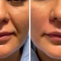 جشنواره پاییزه تزریق ژل و بوتاکس و لیزر موهای زائد