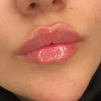ژل و بوتاکس.مزو صورت فقط ۷۰۰  کلینیک زیبایی تخفیف