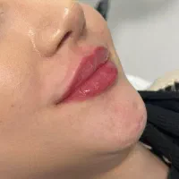 کلینیک/تزریق ژل بوتاکس فیلرزیرچشم/زاویه گونه لیزر