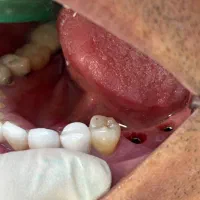 ایمپلنت دیجیتال اقساطی بدون سود در انواع برندها|خدمات آرایشگری و زیبایی|شیراز, زرگری|دیوار