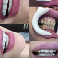 فروش چسب دایم  دندان