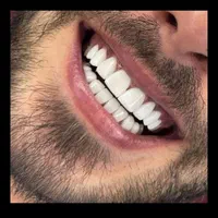 دندانپزشکی کامپوزیت لمینت|خدمات آرایشگری و زیبایی|قم, پردیسان|دیوار