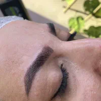 فیبروز میکروبلیدینگ با متد هایپرنچرال و هایپررئال