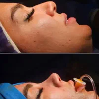 جراحی زیبایی بینی ۳۹میلیون