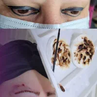 ریمووپاک کردن تتوتاتوابروصورت بدن|خدمات آرایشگری و زیبایی|رشت, فلسطین|دیوار