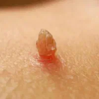 زگیل تناسلیhpv/میخچه/زیگیل/خال/اسکین بواسیر hsv