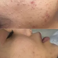 پاکسازی پوست و جوان سازی پوست|خدمات آرایشگری و زیبایی|اراک, |دیوار