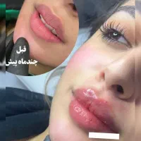 تزریق فیلر و بوتاکس(تخفیفمونو از دست نده)|خدمات آرایشگری و زیبایی|شهریار, شهرک وائین|دیوار