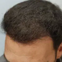 کاشت مو و کاشت اَبرو|خدمات آرایشگری و زیبایی|فسا, |دیوار