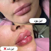 جشنواره مادلینگ ژل و فیلر و بوتاکس صورت 50٪