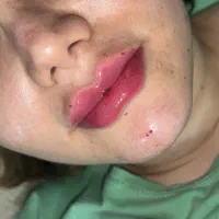 ژل و بوتاکس|خدمات آرایشگری و زیبایی|تاکستان, |دیوار