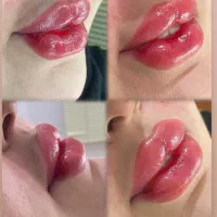 تخفیف ویژه یلدایی بوتاکس و‌فیلر(ژل)