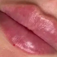 تزریق تخصصی ژل فیلر و بوتاکس کرج وتهران