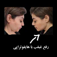 لیزر موهای زائد صورت وبدن،  جوانسازی پوست|خدمات آرایشگری و زیبایی|رفسنجان, |دیوار