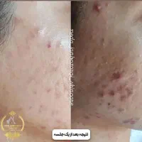 فیشال و پاکسازی پوست زیر نظر متخصص پوست|خدمات آرایشگری و زیبایی|رشت, بوسار|دیوار