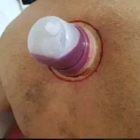 انجام حجامت با بی حسی در منزل و محل کار شما|خدمات آرایشگری و زیبایی|پرند, فاز ۲|دیوار
