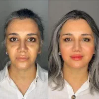 تخفیفات فیلر بادی ،بوتاکس،کانتورینگ توسط پزشک