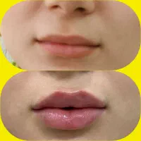 آموزش و تزریق ژل و بوتاکس ومزو|خدمات آموزشی|شیراز, تندگویان|دیوار