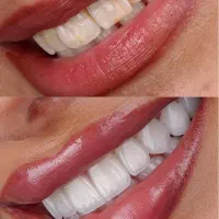 دندان پزشکی/ ایمپلنت بدون بخیه/اوردنچر/روکش|خدمات آرایشگری و زیبایی|تبریز, |دیوار