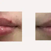 مدل فیلر صورت در کلینیک نوا|خدمات آرایشگری و زیبایی|شیراز, ستارخان|دیوار