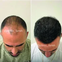 کاشت مو و ابرو طبیعی تکنیک  دکتر آل قیس