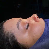 جشنواره ویژه جراحی بینی