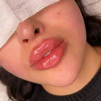 ژل لب/ساکشن غبغب/لیفت/چشم گربه ای/کانتورینگ