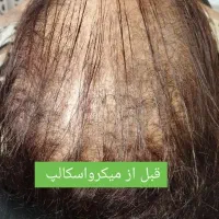 میکرواسکالپ