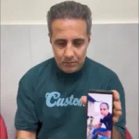 کاشت فول تراکم مو