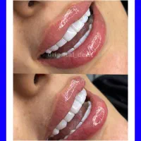 جشنواره ارتودنسی دندان مصنوعی لمینت کامپوزیت پالیش