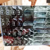 درمان دیسک با دست بدون جراحی