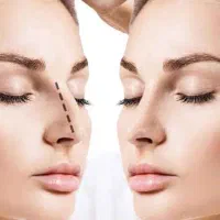 عمل بینی با 200 هزار تومان و بهترین شرایط