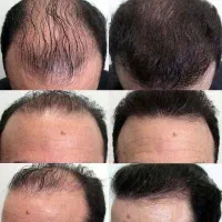 قبل کاشت اینو ببین