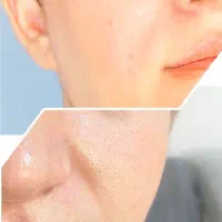 جشنواره ویژه تخفیفی تزریق ژل و بوتاکس و لیزر|خدمات آرایشگری و زیبایی|تهران, نیروی هوایی (پیروزی)|دیوار