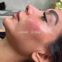 ژل لب فیلر بوتاکس مزو جوانسازی کانتوریگ لیفت نخ|خدمات آرایشگری و زیبایی|تهران, پونک|دیوار