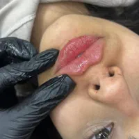 کلینیک تزریق ژل جالپرو لیزر بوتاکس۴۹۰ زاویه پزشک