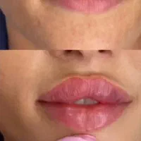 کلینیک زیبایی ژل بوتاکس