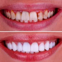 کامپوزیت دندان،لمینت دندان،طراحی لبخند