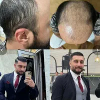 کاشت مو فقط 18میلیون تومان|خدمات آرایشگری و زیبایی|رشت, گلسار|دیوار