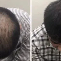 بازگشت پرپشتی مو