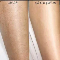 مرکز لیزر با بهترین دستگاه روز دنیا|خدمات آرایشگری و زیبایی|ایذه, |دیوار