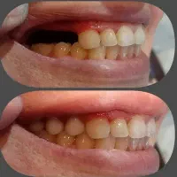 دندان سازی/دندان پزشکی/ایمپلنت/لمینت/دندان