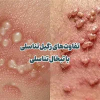 بهبود زگیل تناسلی