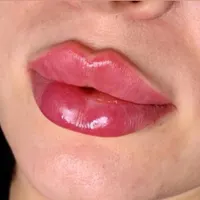 جشنواره فوق تخصصی ژل و بوتاکس با ضمانت
