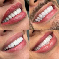 جشنواره دندان ونیر کامپوزیت روکش لمینیت عصب  IMAX|خدمات آرایشگری و زیبایی|تهران, هفت حوض|دیوار