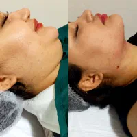لابیاپلاستی/واژینوپلاستی/بوکال فت/ساکشن غبغب/کاشت