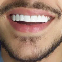 کامپوزیت دندان